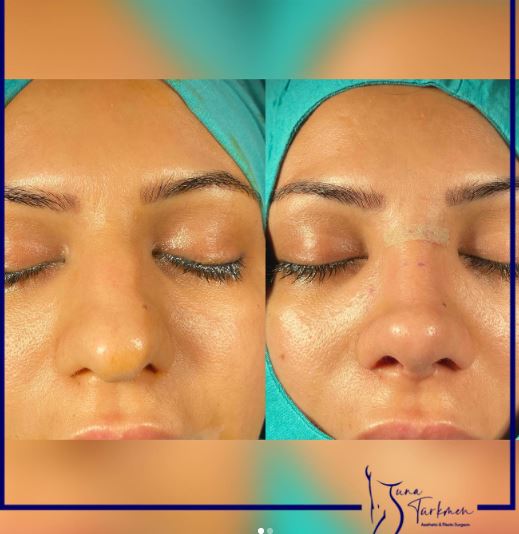 Closed Preservation Rhinoplasty before-after in Istanbul Turkey